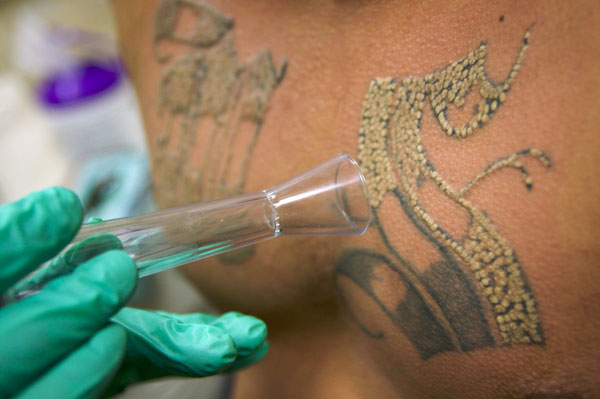 Tattoos Of California. Tattoo removal